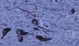 正凡人：：：黑质神经元保存