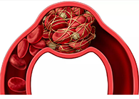 令人“闻风丧胆”的脑卒中发明治疗新机制！！