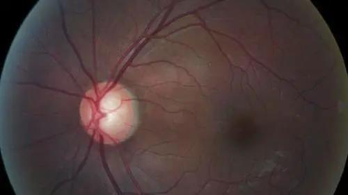 青光眼的克星来袭，助力患者远离视力的“窃贼”