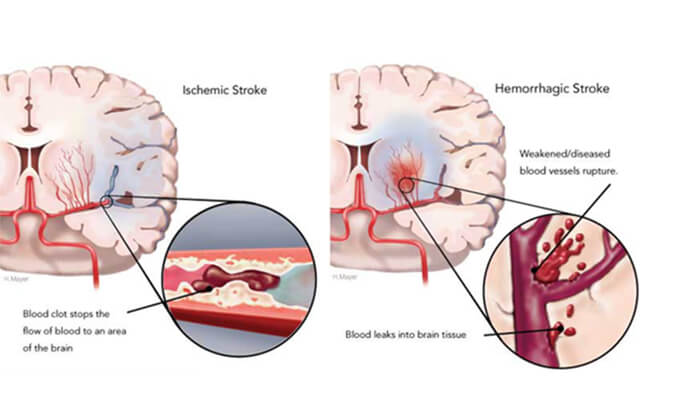 天下卒中日：：从动物药效模子评价看心脑血管药物开发